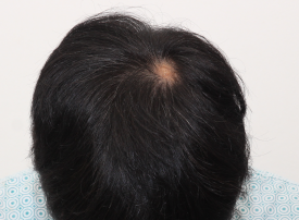 How Should You Start a Hair Loss Management Plan at First? image 3