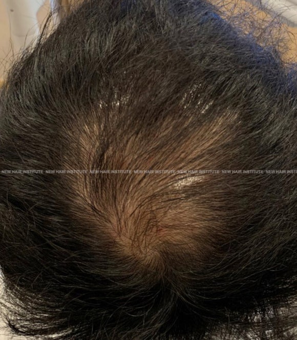 탈모 주사치료 FLEEX 효과 전후사진 비교 관련 이미지 2