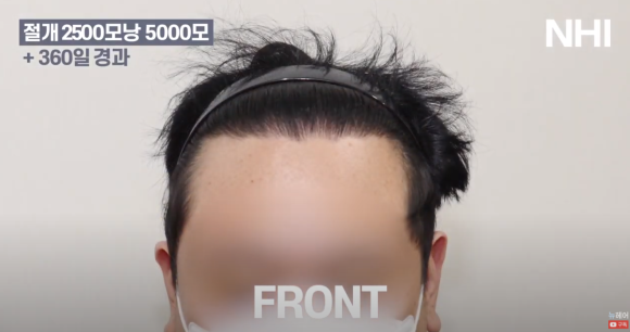 넓은 이마 모발이식 l 탈모 모발이식 후기 사진 관련 이미지 3