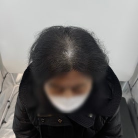 여성두피문신? 60대 실제 사례 사진으로 확인하세요 관련 이미지 6