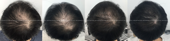 모낭주사가격? 17년차 탈모 치료 의사가 알려드립니다 관련 이미지 4