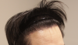 모발이식, 자연스러운 결과를 기대할 수 있을까? 관련 이미지 9