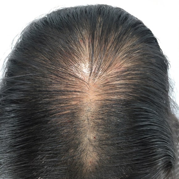 Female Hair Loss Types: It Can Happen Regardless of Age. image 2