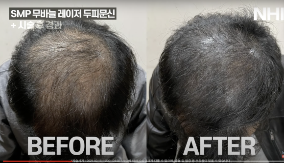 정수리 탈모 두피문신 후기(사진) 보기 l 빗질 영상 관련 이미지 1