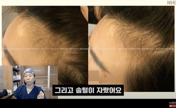 탈모치료 엑소좀, 엑소좀 뜻, 역할, 탈모 치료 효과ㅣ 정수리 탈모 ㅣ 전후사진 관련 이미지 14