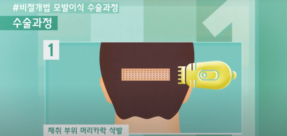 모발이식 수술 뉴헤어에서 알아보기(절개,비절개,헤어라인,모발이식방법,수술) 관련 이미지 10