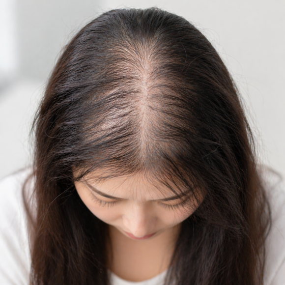 Is Hair Loss in Polycystic Ovary Syndrome Really 83%? image 3