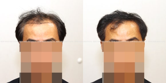탈모 약 복용 시작할 때 주의 사항: 가장 많이 하는 베스트 질문 12 관련 이미지 7