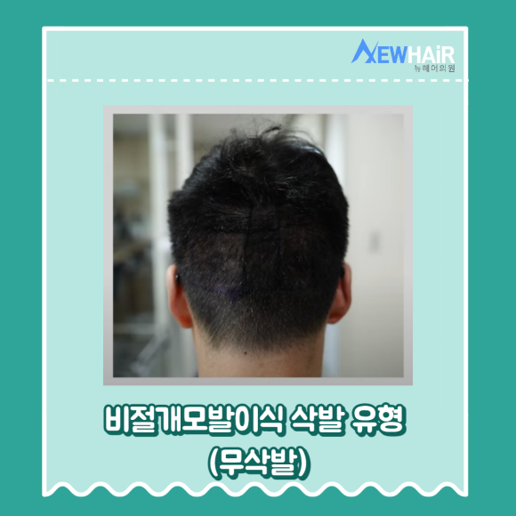 강남비절개모발이식 삭발 유형 알아보기(무삭발,부분삭발,삭발) 관련 이미지 5