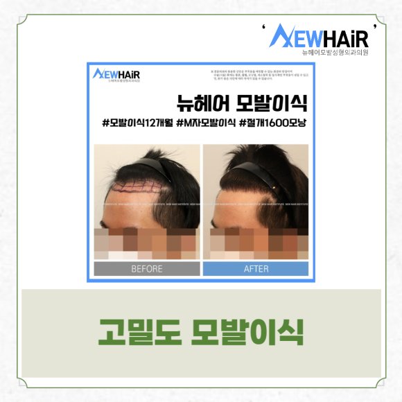 남자헤어라인모발이식 고밀도로 자연스럽게 관련 이미지 3