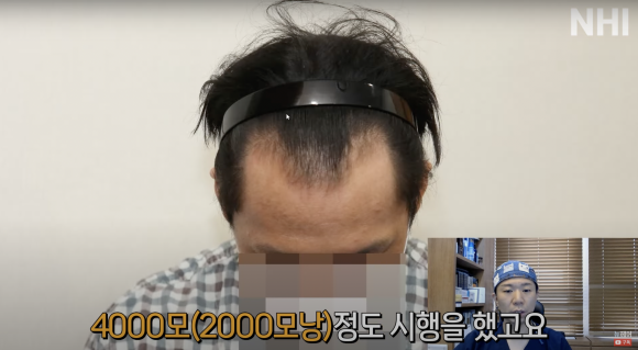 엠자탈모 모발이식 1년 후l 모발이식 후기 #높은이마 #고밀도이식 설명해드립니다 관련 이미지 2