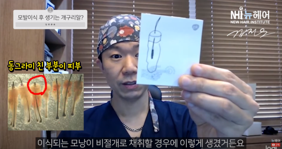 모발이식 개구리알의 진실 l 나도 생길까? 관련 이미지 3