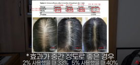 여성탈모는 남성용 미녹시딜을 써라?(효과,부작용) 관련 이미지 6