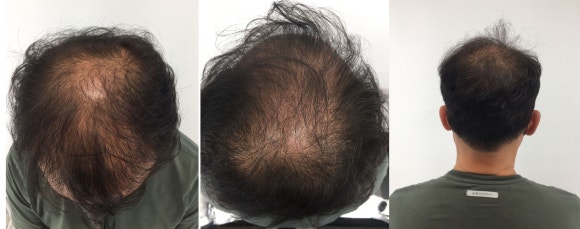 남성탈모치료 6개월 받은 50대 남성 후기 관련 이미지 3