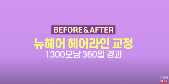 여자 모발이식 재수술 헤어라인교정 l  1300모낭 1년 경과 사진 l 3차 재수술 관련 이미지 1