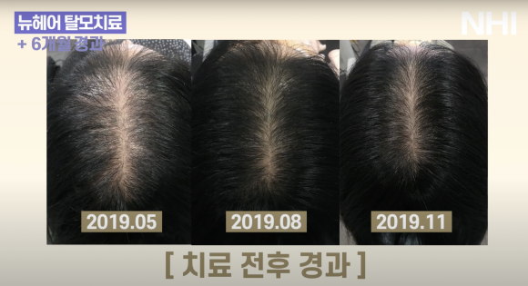 보툴리눔 톡신 탈모치료 l 6개월 치료 후기 사진 관련 이미지 2