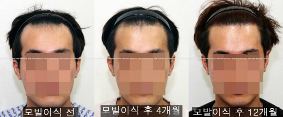 모발이식 후 결과는 언제 볼 수 있을까? 관련 이미지 3