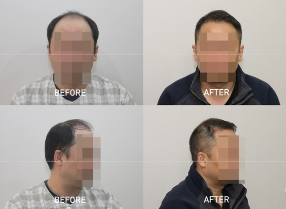 모발이식 최적화 배치, 같은 수술을 받아도 결과가 다른 이유 관련 이미지 2