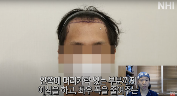 엠자탈모 모발이식 1년 후l 모발이식 후기 #높은이마 #고밀도이식 설명해드립니다 관련 이미지 1