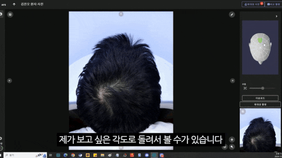 탈모검사, 치료 전 필수인 이유! 관련 이미지 4
