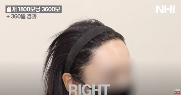 [뉴헤어] 여자 헤어라인교정 1800모낭 360일 이식 후기 관련 이미지 4