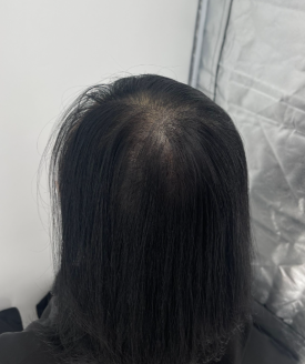 모발문신후기? 탈모치료와 병행한 40대 여성 환자분 사례 관련 이미지 9