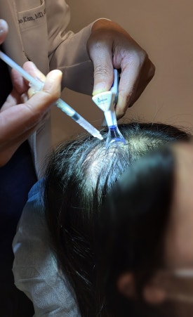 Autologous Cell Hair Loss Treatment, Treatment Using Autologous Follicle Cells image 3