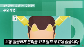 A Complete Guide to Non-Incisional Hair Transplant Methods image 9