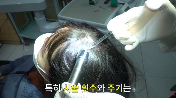 What Are the Effects and Side Effects of Follicular Injections? image 5