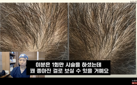 탈모치료 엑소좀, 엑소좀 뜻, 역할, 탈모 치료 효과ㅣ 정수리 탈모 ㅣ 전후사진 관련 이미지 13