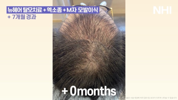 정수리탈모 엑소좀관리 7개월 경과 전후사진 관련 이미지 3