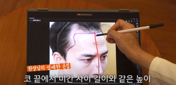 얼굴형에 따라 달라지는 모발이식 헤어라인, 황금비율이 있을까? 관련 이미지 1