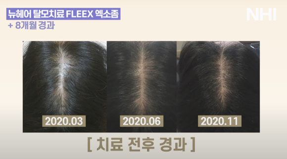 가르마 탈모치료(모낭주사) 8개월 경과 후기 사진 l  탈모치료 관련 이미지 5
