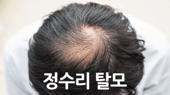 탈모치료방법, 비수술로 해결될까요? 관련 이미지 10