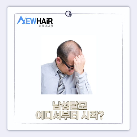 남성탈모 모발이식으로 해결 관련 이미지 2