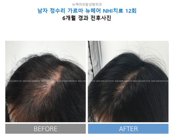 탈모약을 먹을까, 탈모시술을 받을까. 나에게 맞는 탈모 치료는? 관련 이미지 3