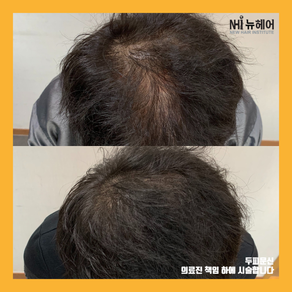 정수리 탈모 두피문신 전후 사진 모음 l 뉴헤어 관련 이미지 2