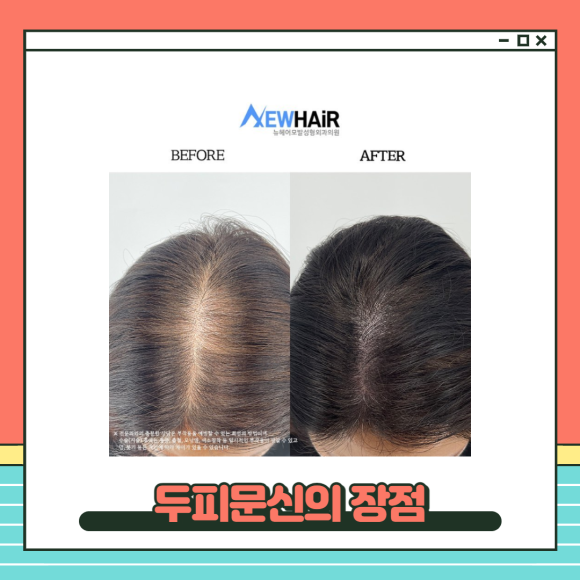 정수리 가르마두피문신 수술없이 탈모해결 관련 이미지 3