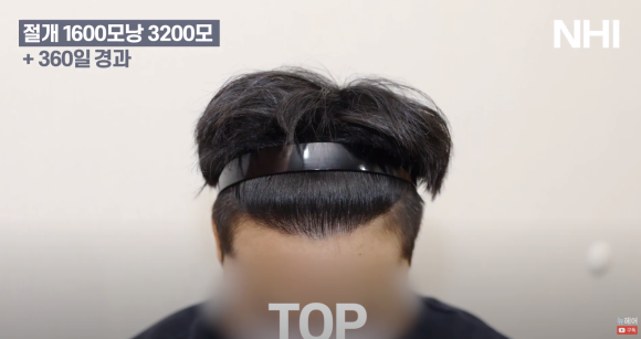 남자 모발이식 1600모낭 1년 지난 후 사진 경과 후기 관련 이미지 7