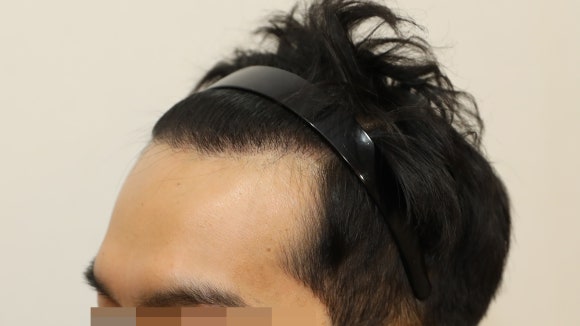 Hair Loss Treatment: Different Strategies by Area (When Combination Treatment Is Used) image 6