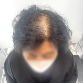 여성두피문신? 60대 실제 사례 사진으로 확인하세요 관련 이미지 3