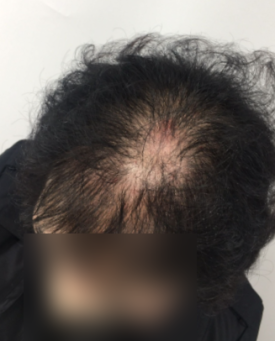 여성 탈모 주사, 의료진이 적극 권하는 2가지 이유? 관련 이미지 1