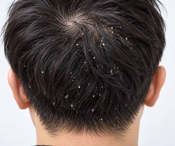 비듬 때문에 탈모가 생길까 두피 가려움과 탈모 관계 관련 이미지 1