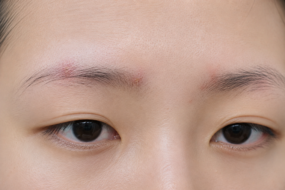 Eyebrow Hair Loss: Could It Be a Symptom of Seborrheic Dermatitis? Causes and How to Check image 2