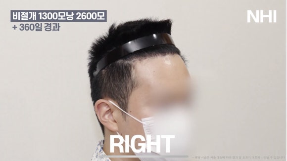 남자 앞머리 모발이식 l 탈모 모발이식 1년 전후 사진 관련 이미지 7