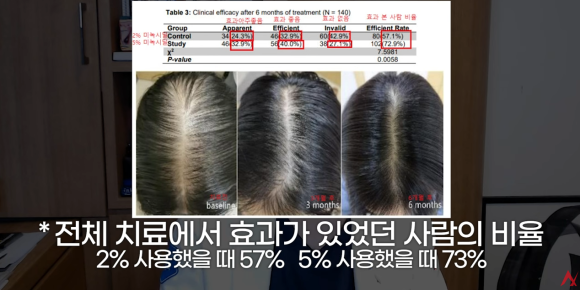 여성탈모는 남성용 미녹시딜을 써라?(효과,부작용) 관련 이미지 8