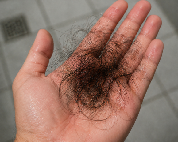After Hair Transplantation, Is Shock Loss a Failure? (Causes · Timing · How to Respond) image 1