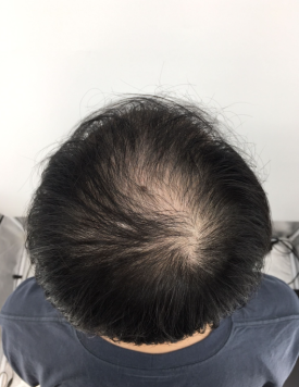 탈모치료주사? 효과 있을까 궁금하신 분들만 보세요 관련 이미지 3