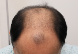 가족력탈모, 언제부터 살펴보는 게 좋을까? 관련 이미지 2