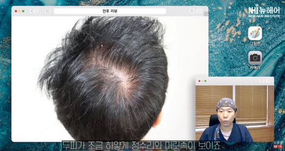 두피문신 전 필독! 두피문신도 테스트가 가능하다? 관련 이미지 2